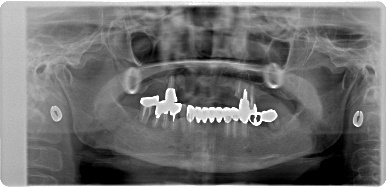 インプラント臼歯 レントゲン
