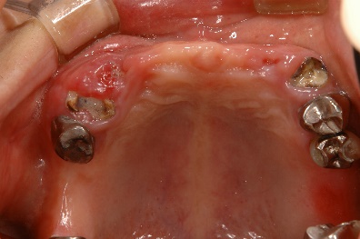 インプラント臼歯 上