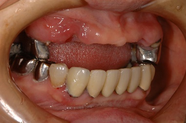 インプラント臼歯 右