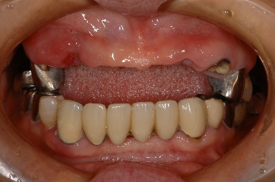 インプラント臼歯 正面
