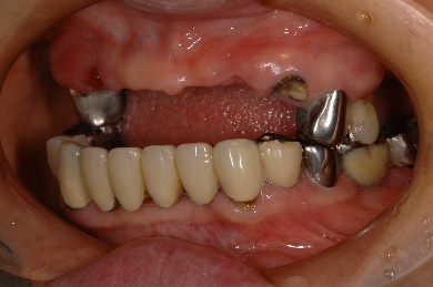 インプラント臼歯 左