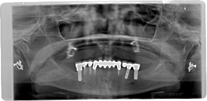 インプラント臼歯 レントゲン