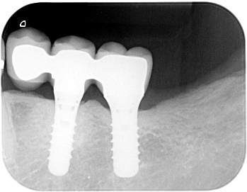 インプラント臼歯 レントゲン 横部分