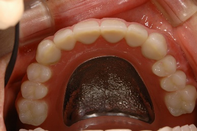 インプラント臼歯 上