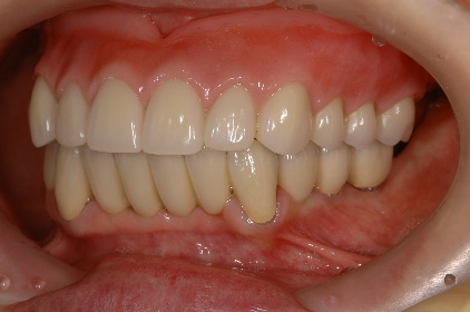 インプラント臼歯 左