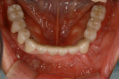 インプラント臼歯 下