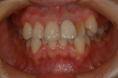 オールセラミッククラウン症例4（複数歯）