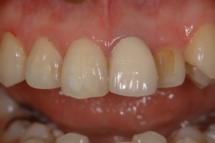 オールセラミッククラウン症例4（複数歯）