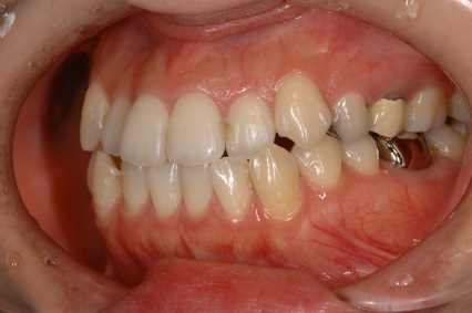 歯内療法症例１