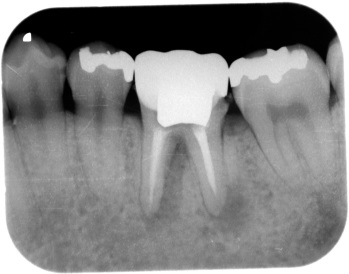 歯内療法症例１