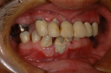 インプラント臼歯2