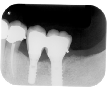 インプラント臼歯2