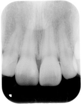 ラミネートべニア症例3（歯冠色変更）