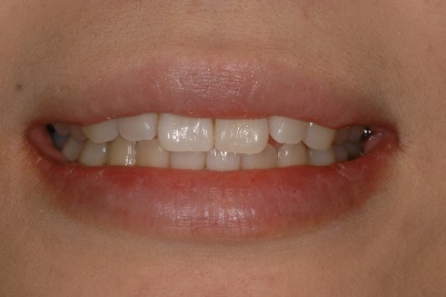 ラミネートべニア症例3（歯冠色変更）