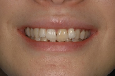 ラミネートべニア症例4（歯冠色変更）