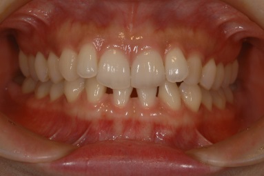 ラミネートべニア症例4（歯冠色変更）