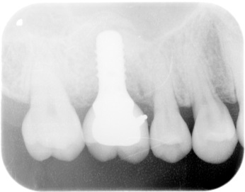 インプラント臼歯3