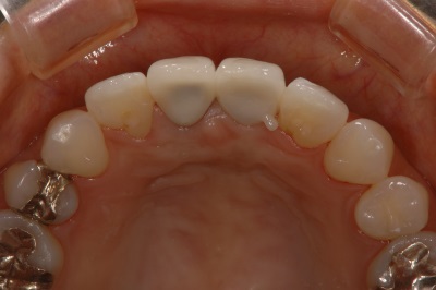 インプラント前歯症例１