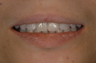 インプラント前歯症例１