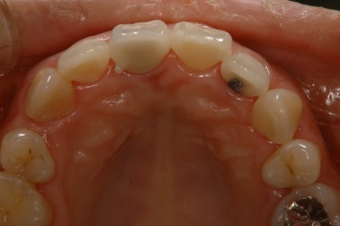 インプラント前歯症例２