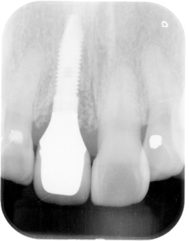 インプラント前歯症例２