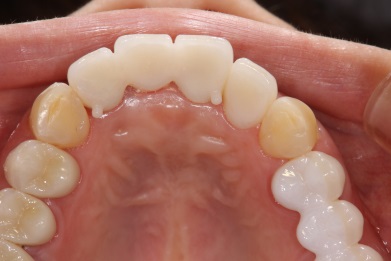 インプラント前歯症例３