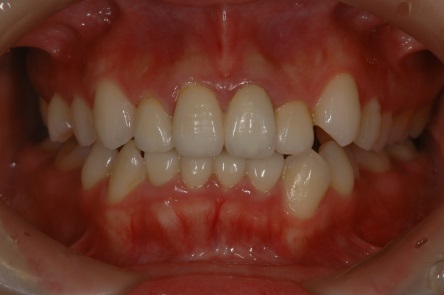 オールセラミッククラウン症例3（複数歯）