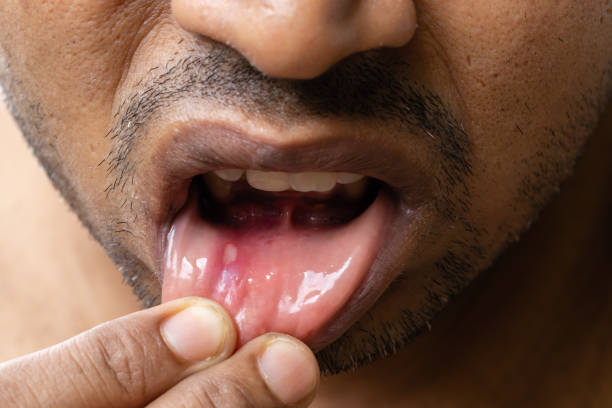 歯茎の口内炎が痛い！ 種類・原因・つらい痛みを解消する方法【前編】
