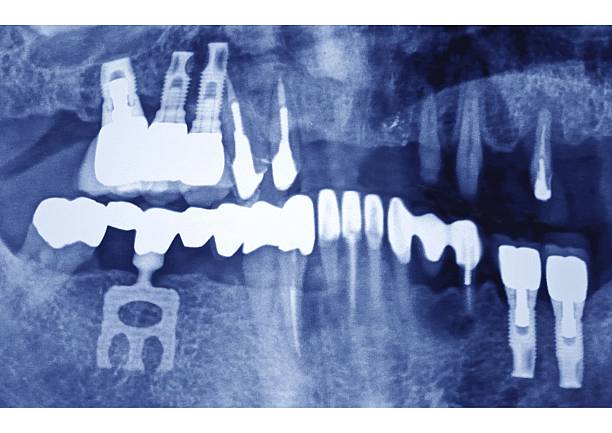 Dental Implant, X-Ray, Dental Panoramic X-Ray, Reconstruction Of Various Teeth. (Photo By BSIP/Universal Images Group via Getty Images)