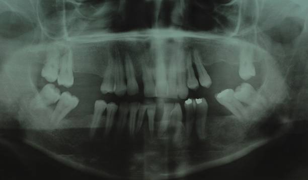 Black and white x-ray of teeth of young adult (Photo by Universal Images Group via Getty Images)